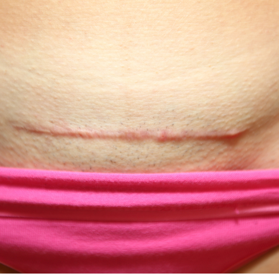 C Section Self-Care Healing And Recovery