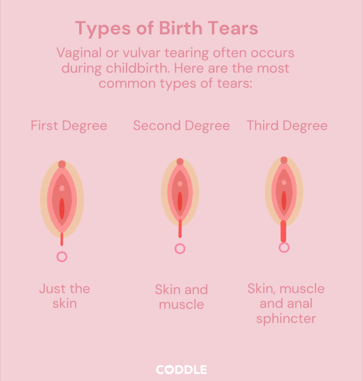 How Do You Know If Your Perineal Tear Is Healing?